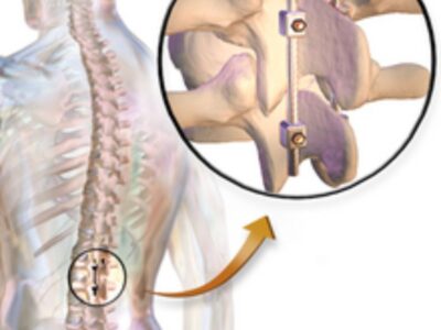 Best Hospitals for Spinal Fusion Surgery india