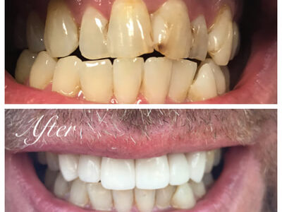Tooth bonding services in Goodlettsville, TN | Goodlettsville Family Dentist