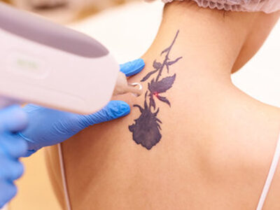 Tattoo Removal Treatment in Patiala | Petals Aesthetics