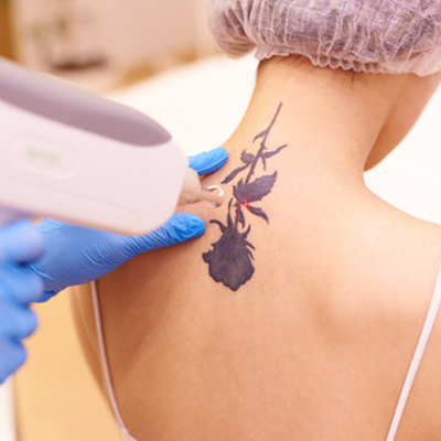 Tattoo Removal Treatment in Patiala | Petals Aesthetics