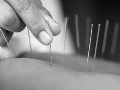 Acupuncture in Brighton for Holistic Health & Wellness