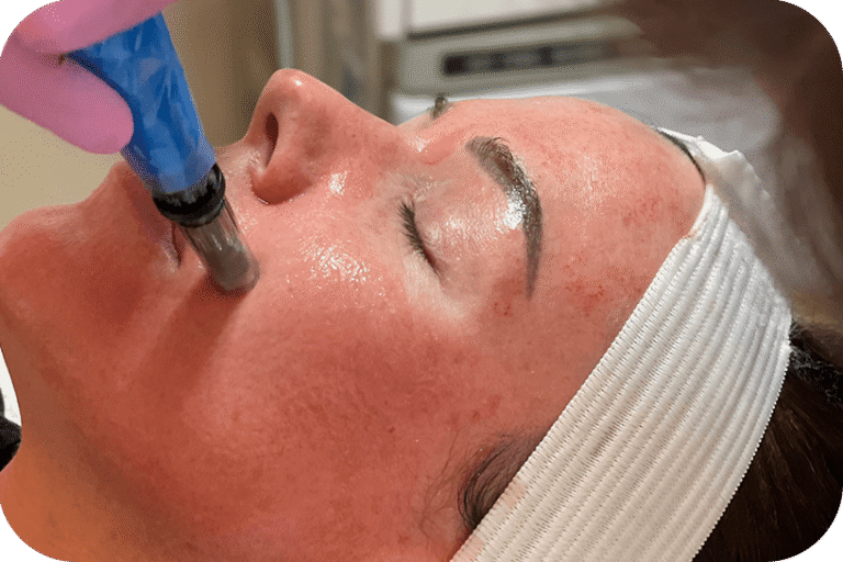 Microneedling Treatment 768x512