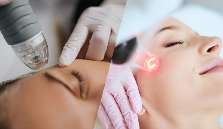 Microneedling Treatment1 768x445