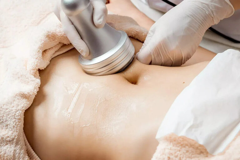 Laser Lipolysis Treatment 01 768x512